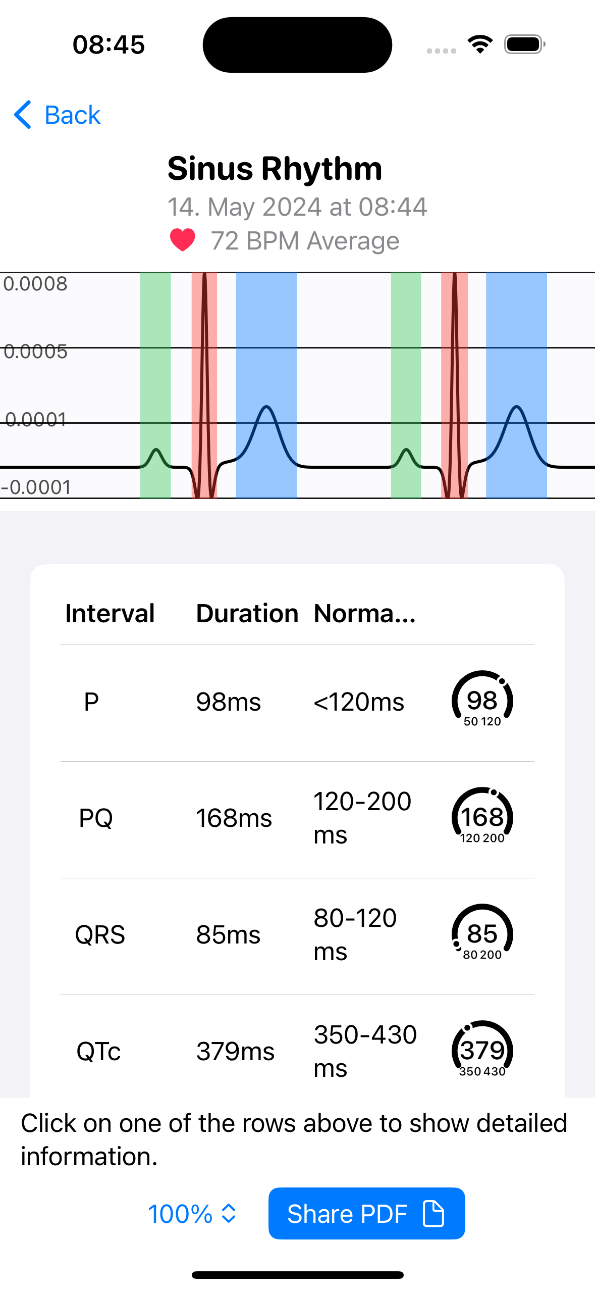 ECG AI App - Main ECG Analysis Screen with Apple Watch Integration